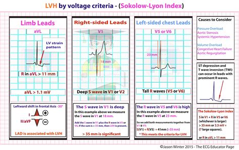 voltage criteria for lvh ekg